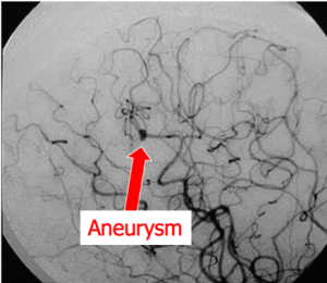 Brain aneurysm